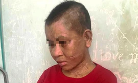 Chị Y Nhiêu bị đánh đập với nhiều vết thương khắp người