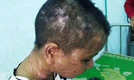 Hàng trăm vết thương từ đầu xuống chân Y Nhiêu