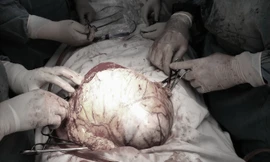 Bác sĩ phẫu thuật cắt khối u 'khủng' cho bệnh nhân.