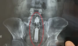 Sextoy kẹt trong trực tràng nam thanh niên.