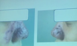 Bỏ ra 1,5 triệu để nâng mũi, hiện tại cô gái trẻ đã tốn hơn 30 triệu để điều trị biến chứng.