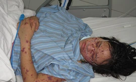 Các ban đỏ điển hình của bệnh nhân viêm não mô cầu. (Ảnh minh hoạ)