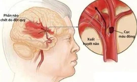 Mỗi giờ có 12 người chết vì đột quỵ