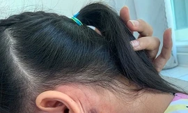 Ghi nhận bệnh nhân nhiễm vi khuẩn Whitmore thứ 2 tại Bình Định.