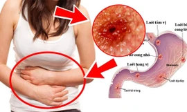 Đau dạ dày gây ảnh hưởng lớn đến người bệnh