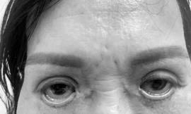 Tin lầm lang băm cắt mí 'chui', người phụ nữ khóc thét vì đôi mắt trợn ngược 