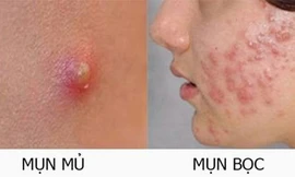 Tại sao phải dành cả thanh xuân để trị mụn khi chỉ cần bí kíp đơn giản đến không ngờ?