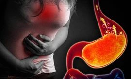 ‘Trào ngược dạ dày thực quản’ – Bệnh lối sống đang gia tăng ở Việt Nam