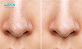 Cách trị mụn đầu đen hiệu quả: Những việc nên và không nên làm