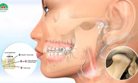 Niềng răng sinh học: mang công nghệ vào niềng răng