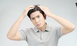 Giải pháp toàn diện nào cho tình trạng gàu ngứa dai dẳng trong mùa hè oi bức?