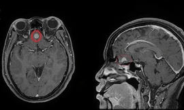 Cảnh giác phát hiện u màng não từ biểu hiện đau đầu thường xuyên