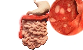 Viêm đại tràng dễ biến chứng nguy hiểm