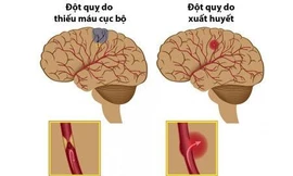 Đột quỵ - Nguyên nhân gây bệnh và cách phòng ngừa hiệu quả