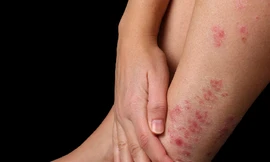 Bật mí nguyên nhân và cách điều trị bệnh vảy nến ở chân
