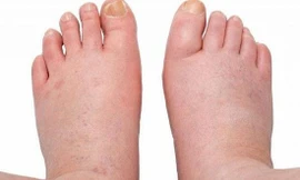 Cảnh báo dấu hiệu bệnh suy thận - Chớ xem thường kẻo hối hận không kịp