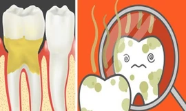 Bỏ túi ngay các mẹo hay trị hôi miệng