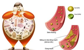Báo động tình trạng đột quỵ tại Việt Nam