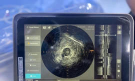  Cấp cứu thành công ca lóc tách động mạch vành nhờ kỹ thuật siêu âm trong lòng mạch