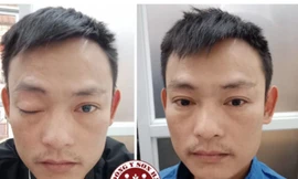 Tại sao liệt dây thần kinh số 3 gây sụp mí mắt?