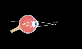 Cơ chế tạo ảnh trên võng mạc. Khi điểm hội tụ ảnh nằm trước võng mạc, đó là cận thị