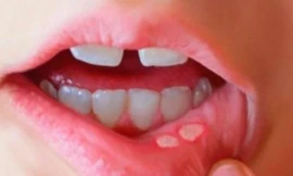 Nhiệt miệng, nhiệt lưỡi, nhiệt lợi tái phát – Xem ngay giải pháp