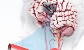 Khỏe mạnh lại sau tai biến nhờ phương pháp từ Nhật Bản và vật lý trị liệu