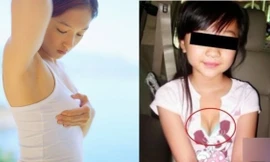 Ngực to bất thường, dấu hiệu dậy thì sớm của trẻ