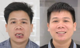 Bí quyết thành công của công nghệ trồng răng implant DCT