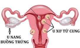 Nga Phụ Khang giúp cải thiện u xơ tử cung, u nang buồng trứng