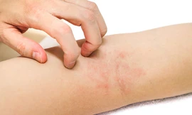 Ngứa da - Triệu chứng điển hình của viêm da cơ địa