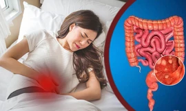 3 sai lầm khiến bệnh hội chứng ruột kích thích dễ biến chứng