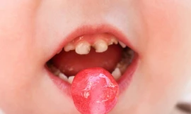 Tầm quan trọng của răng sữa, điều ít mẹ biết