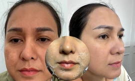 Peel da và những điều cần lưu ý