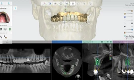 Bước đột phá mới trong việc giảm thiểu nguy cơ biến chứng trong cấy ghép implant đầu năm 2024