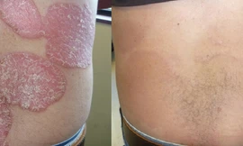 Kiểm soát hiệu quả bệnh vẩy nến bằng kết hợp thảo dược