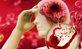 Mỡ máu cao gây biến chứng đột quỵ não