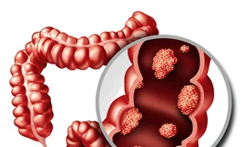 3 sai lầm của người viêm đại tràng khiến bệnh tái phát liên tục