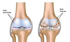 Thiếu hụt chất nền sụn khớp – Thủ phạm gây đau nhức và thoái hoá xương khớp