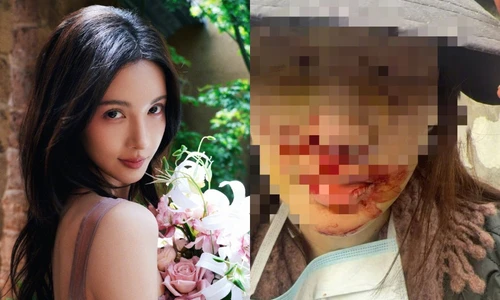 Kim Thần công bố ảnh bị thương nặng ở mặt, cảnh sát làm rõ vụ gây tai nạn bỏ trốn