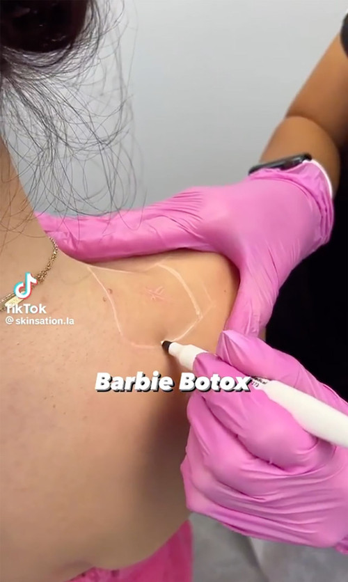 Thẩm mỹ bằng phương pháp Barbie Botox có thể gây hại cho sức khoẻ. Ảnh: TikTok.