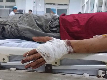 Ông Lý được các bác sỹ nối lại bàn tay bị đứt lìa.