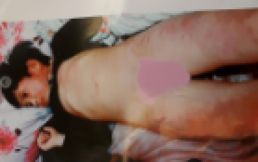 Hình ảnh cháu Dương bị bầm tím khắp người (ảnh do gia đình cung cấp) 