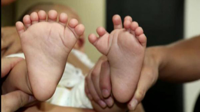 Bé trai có tổng cộng 16 ngón trên bàn tay và 15 ngón chân nhưng lại không có ngón tay cái hay ngón chân cái nào.