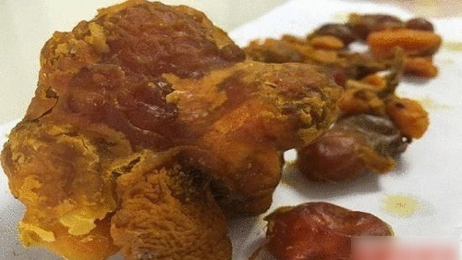 Dị vật nghi là "kê bảo" do anh Ngô tìm thấy trong bụng gà. Ảnh: Top-news.top.