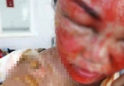 Chị Ng. bị bỏng nặng đang được điều trị tại bệnh viện