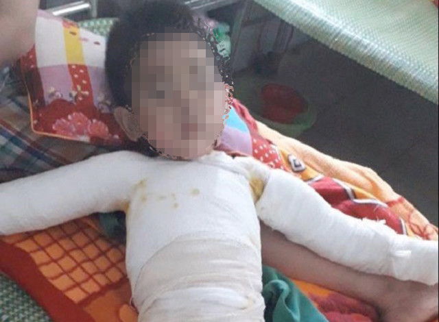 Ghép da 3 lần, bệnh nhi 5 tuổi bị bỏng nặng toàn thân được cứu sống