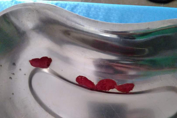 Bác sỹ ‘bắt’ 4 con sán lá gan trong dạ dày một phụ nữ