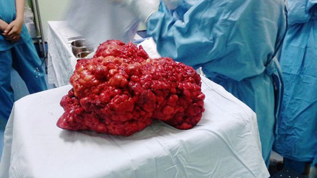 Khối u nặng 4,3kg lấy ra khỏi cơ thể bệnh nhân. Ảnh: Lao Động