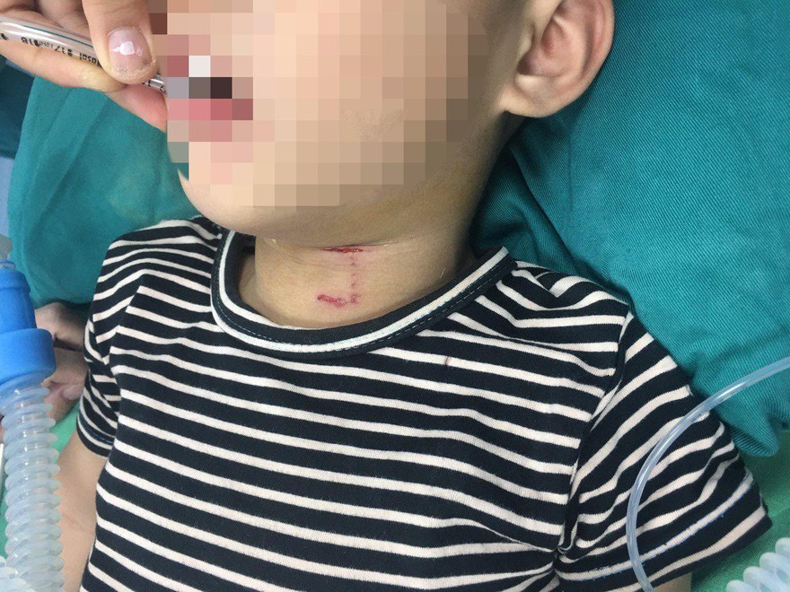 Bé 3 tuổi bị chó cắn rách vùng cổ, thủng khí quản